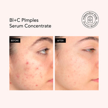 Bl+C Pimples • Black Cumin + Cajeput • Serum Concentrate