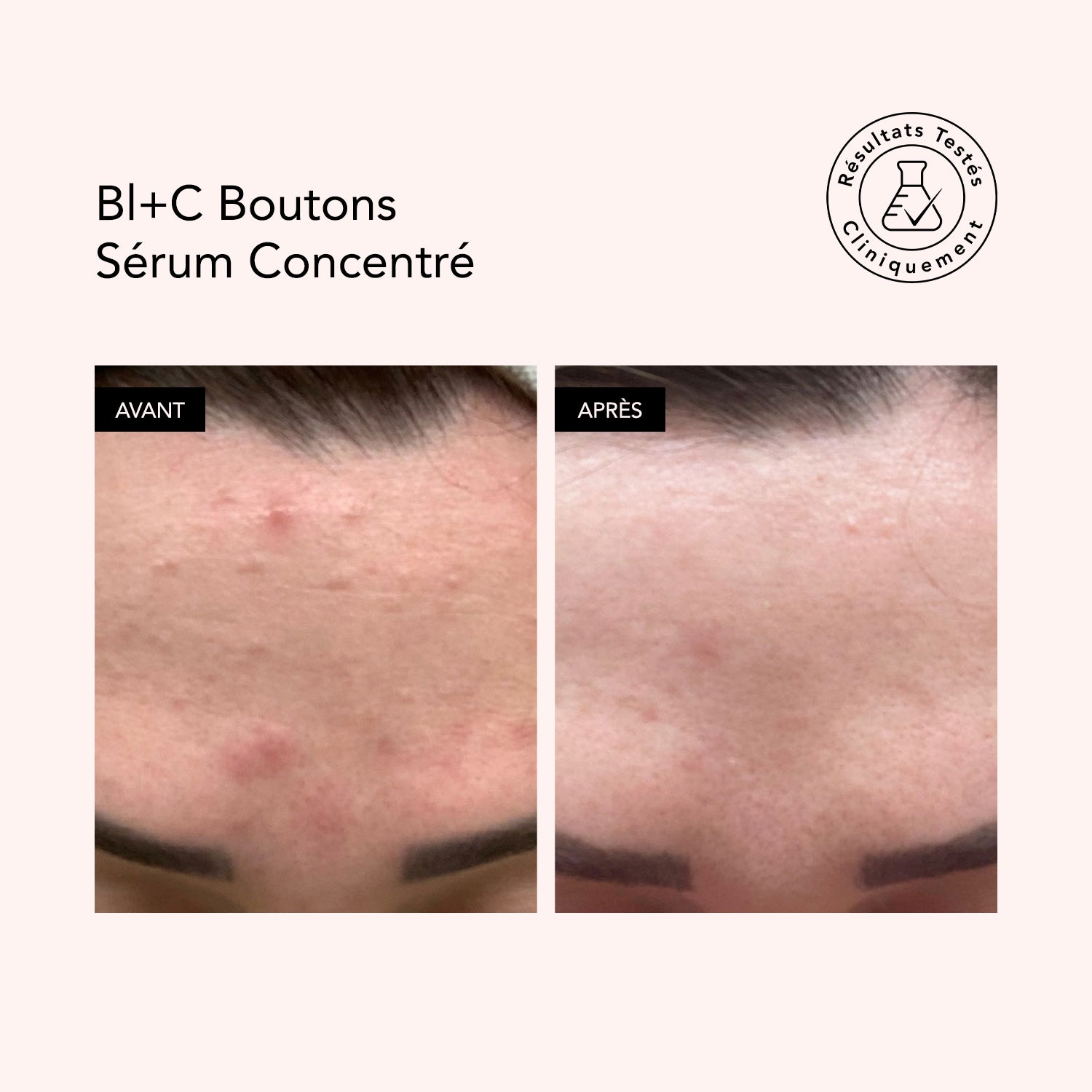 Sérum Concentré Boutons Bl+C Nigelle+Cajeput